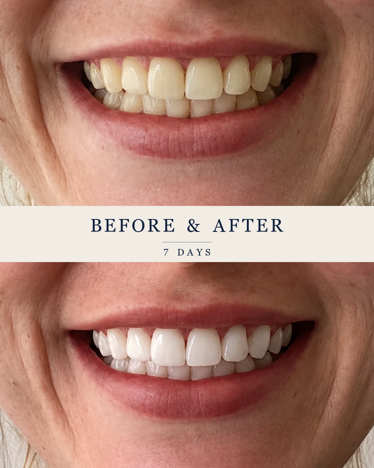 A customer’s smile photographed before and after seven days with the SmilePro Advanced Whitening Kit, the lower photo several shades lighter.